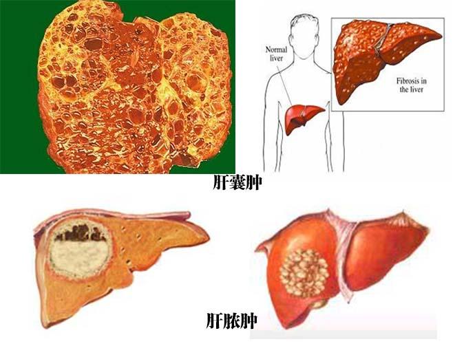 什么是肝囊肿？为什么会出现肝囊肿呢-图2