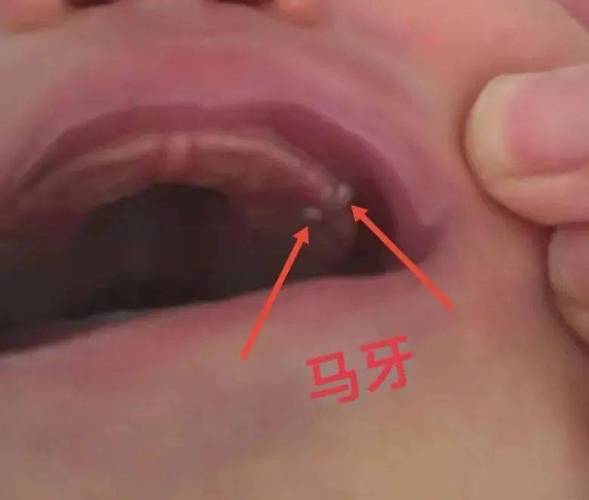 马牙和乳牙的区别是什么啊？还是分辨不太清楚了的？宝宝为什么会长马牙呢
