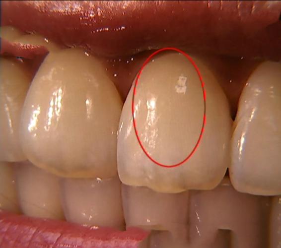 牙齿有裂缝能自愈吗？牙齿为什么有裂纹呢