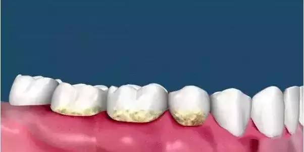 牙垢长得快什么原因？为什么会长牙垢呢