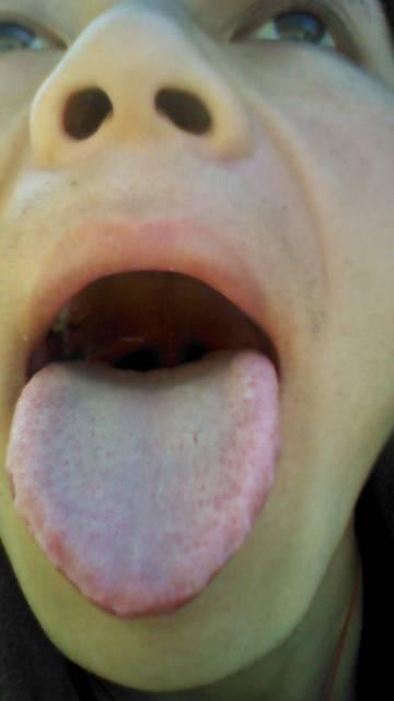 口干舌燥，舌头有齿痕，这种病有没有什么好的治疗方法呢？为什么会口干舌燥呢-图1