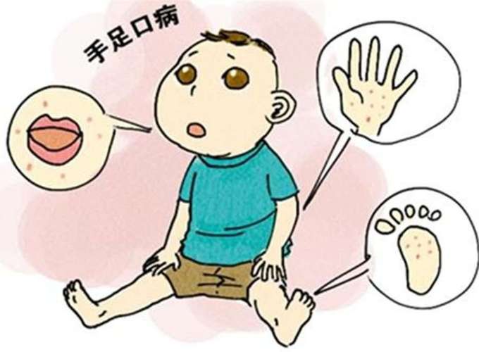 手足口病的传染源有哪些？为什么会得手足口病呢-图3