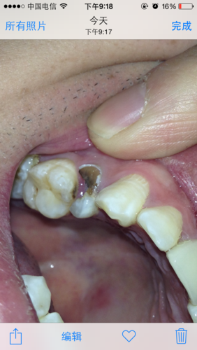 牙齿一块块的掉是什么原因？牙齿为什么会掉呢