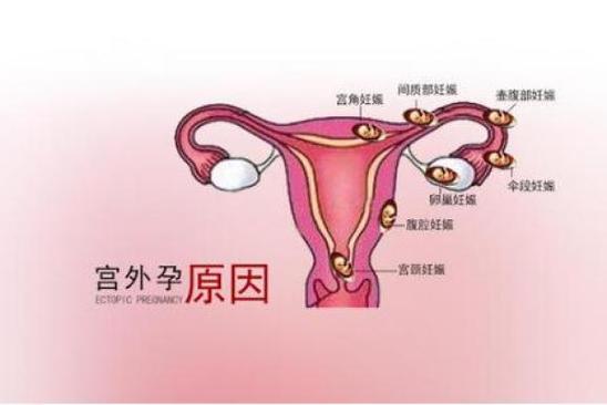 宫外孕是否可以转化为宫内孕？为什么会得宫外怀孕呢-图1
