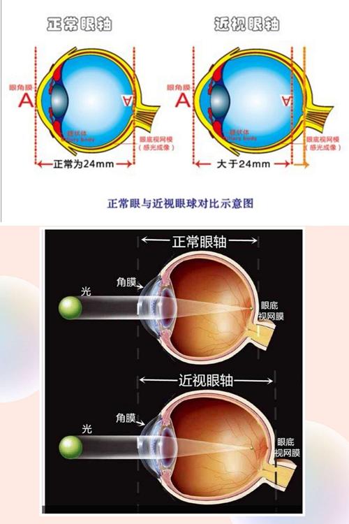 近视眼是哪些结构发生变化？眼睛为什么会近视呢-图2