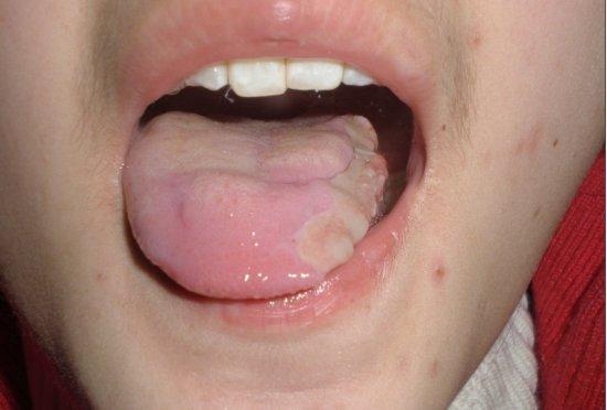 嘴里为什么经常起溃疡？为什么嘴巴总是溃疡呢