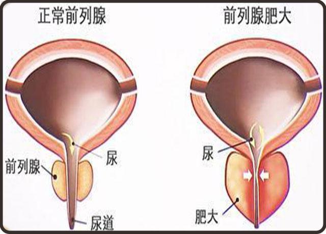 前列腺增大是怎么回事？为什么会出现前列腺增生呢