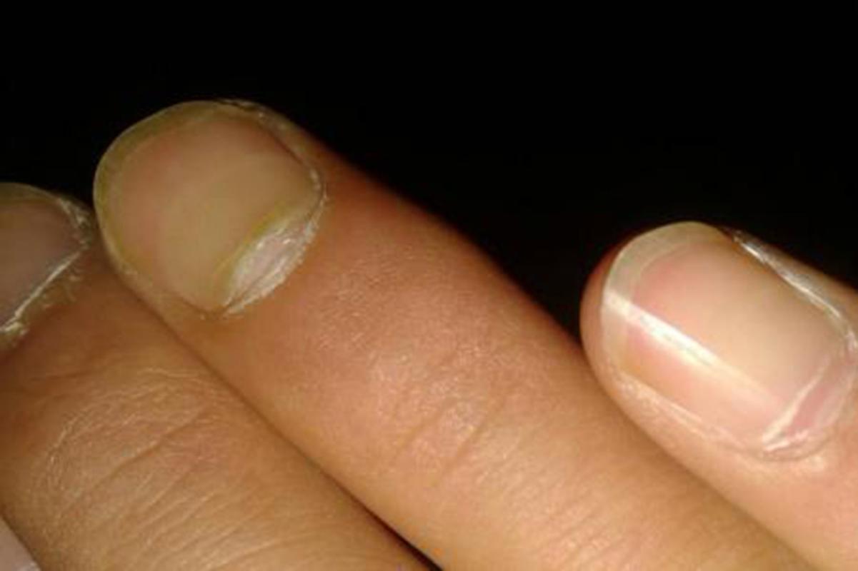 指甲发黄是什么原因，手指甲发黄是什么病症？指甲为什么会变黄呢