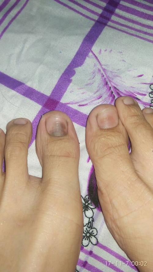 大脚指甲变黑什么原因？脚指甲变黑为什么会痛呢