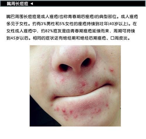 脸上下巴两侧长痘痘是什么原因？这是怎么了？为什么脸上会长豆豆呢