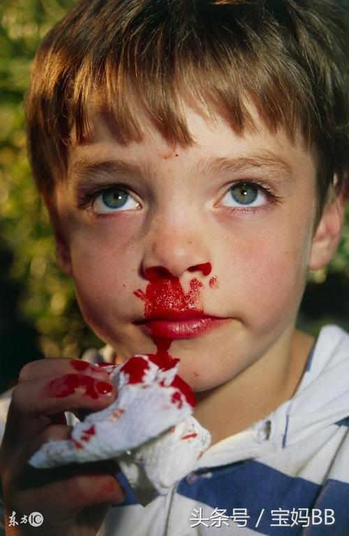 孩子老流鼻血是怎么回事？为什么小孩会流鼻血呢