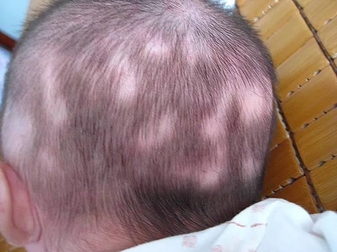 2岁的小孩子为什么掉头发?特别是洗头时特别多？为什么会头发掉发呢