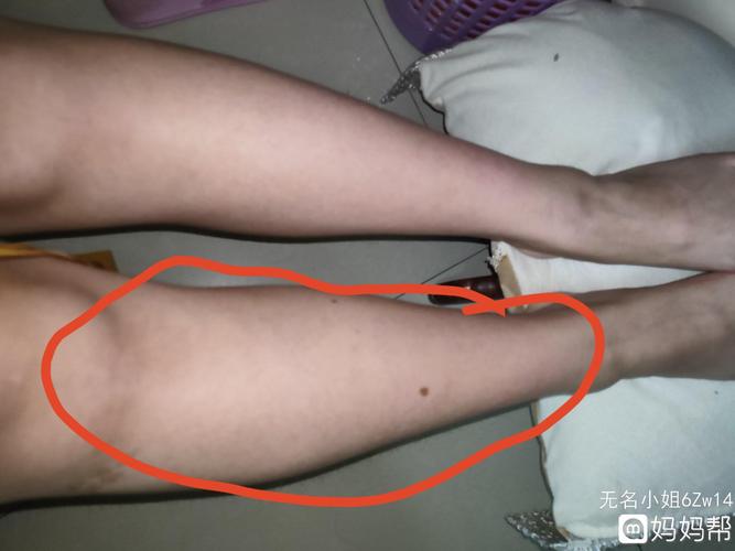 小腿出现水肿现象，该情况一般什么情况下会出现水肿？为什么小腿有点浮肿呢呢