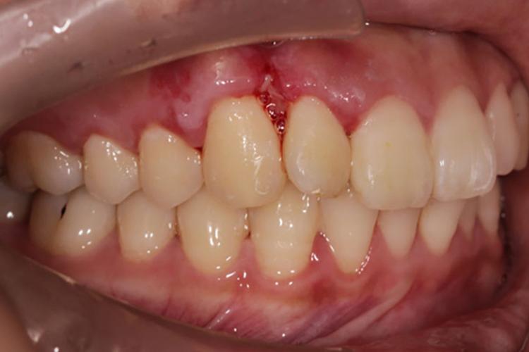 刚镶的牙牙龈出血怎么回事？为什么假牙爱出血呢呢
