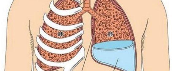 肺部积水是什么病？为什么肺部会积水呢呢-图2