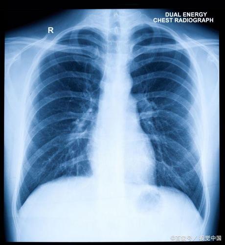 肺部积水是什么病？为什么肺部会积水呢呢-图3