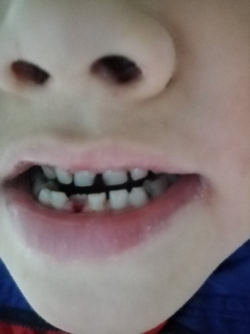 十岁男童连续掉牙正常吗？为什么小孩经常掉牙呢呢