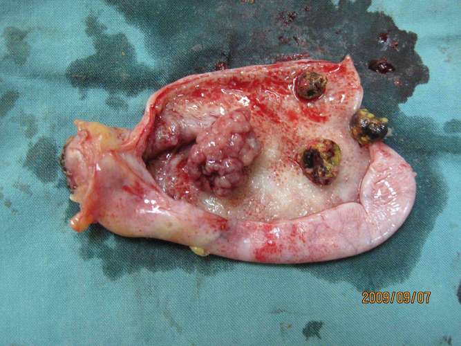 胆囊息肉如何形成的？为什么胆囊会长息肉呢呢