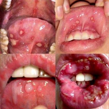 口腔有灼热感什么病？为什么口腔会发炎呢呢