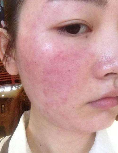 脸部皮肤瘙痒的原因是什么呢？为什么脸老过敏呢呢