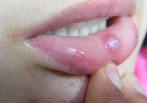 嘴唇里面起泡是什么原因？为什么嘴巴常起泡呢呢-图1