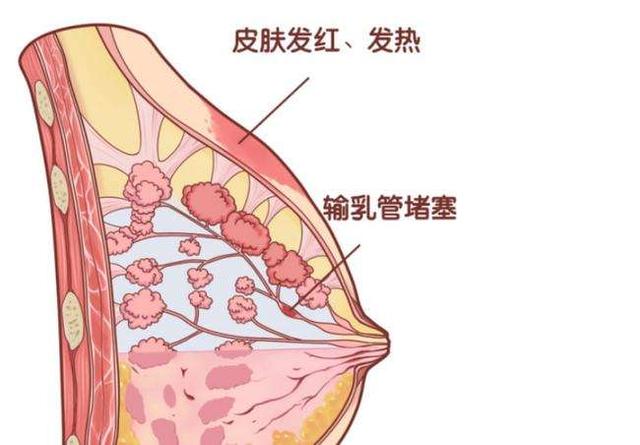 奶管堵塞乳房涨痛怎么办，经常乳管堵塞的原因？为什么乳腺总是堵呢呢-图2