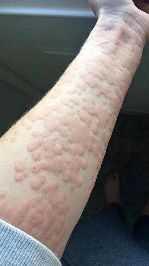 每天晚上起荨麻疹是怎么回事？为什么晚上会过敏呢呢