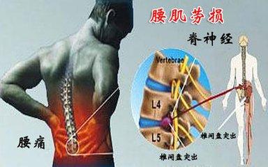 腰部酸痛是什么原因？为什么腰总会酸痛呢呢-图1