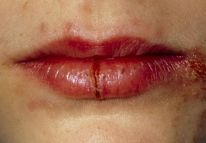 嘴唇干裂原因是什么？为什么嘴唇会干裂呢呢