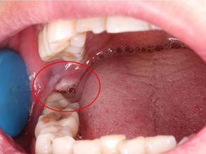 长智齿牙疼是什么病造成的？智齿为什么老发炎呢呢