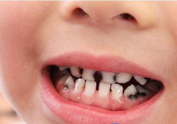儿童长大牙牙疼怎么办？为什么会牙疼啊又没有吃糖？为什么现在吃糖牙疼呢呢
