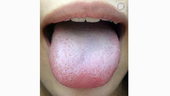 舌头苔白是什么回事？为什么总是舌苔发白呢呢-图2