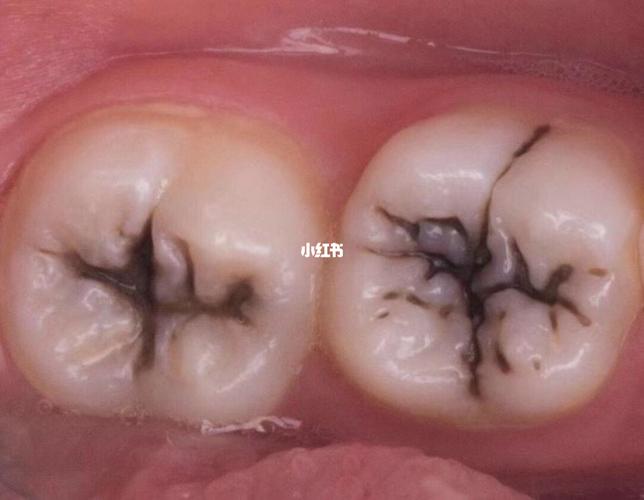 牙齿变黑的原因是什么？为什么牙齿会腐烂呢呢