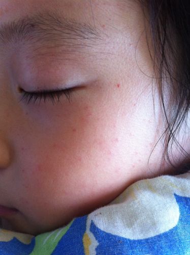 宝宝有些感冒咳嗽，脸上长了红点点，为啥会这样子？感冒为什么会脸红呢呢