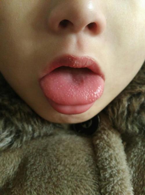 舌头痒痒是怎么回事？舌尖为什么痒呢