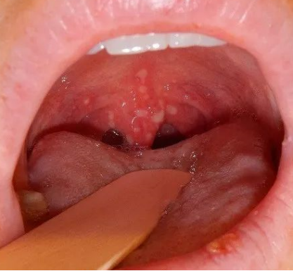 喉咙长疱疹怎么回事？为什么会长疱疹呢