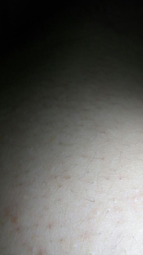 我的背部长了很多的点点黑斑是什么原因？为什么还有黑斑呢