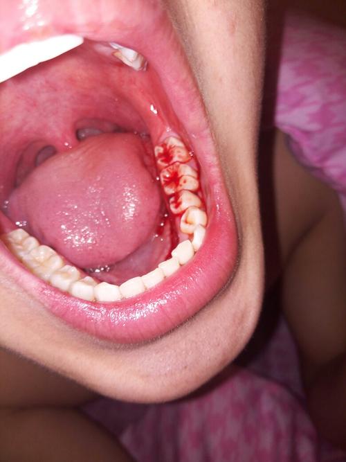 牙流血是什么原因？牙齿为什么流血呢