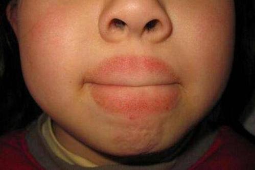 怎么控制孩子舔嘴？为什么小孩老舔嘴唇呢呢-图3