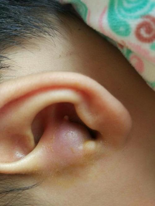 耳朵发炎流脓怎么治？为什么耳朵要灌脓呢呢