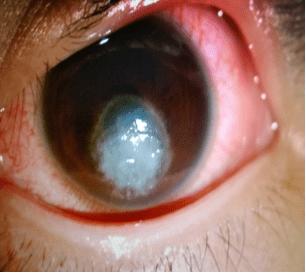 什么是眼角膜炎？黑眼球为什么会溃疡呢呢