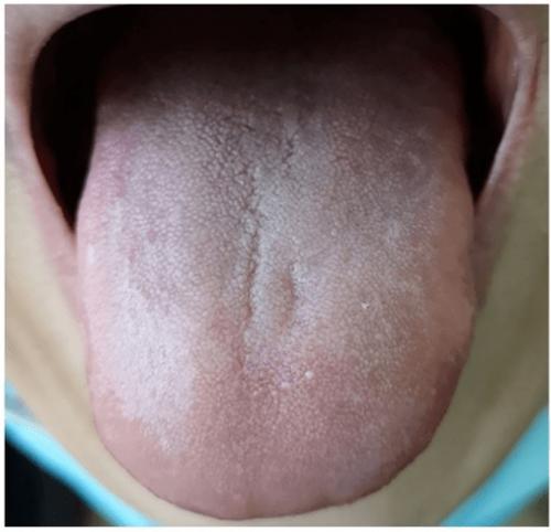 不知道舌苔什么样是正常的？为什么舌头上有舌苔呢呢