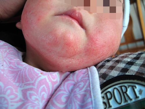 宝宝脸上长湿疹是什么原因？五个月多宝宝，要怎么治疗哪？婴儿为什么会患湿疹呢呢-图2