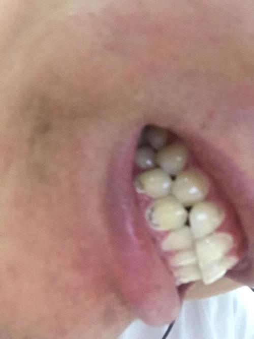 为什么牙齿缝隙很臭？牙齿没坏为什么臭呢呢