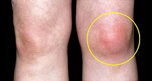 最近来例假第一天膝盖疼，是什么原因？为什么来姨妈膝盖痛呢呢