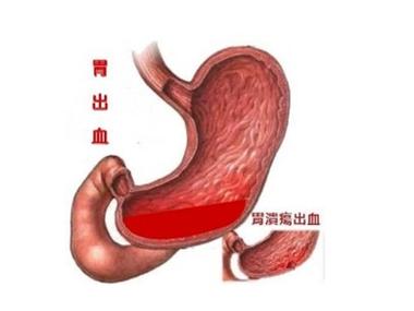 胃出血都有什么症状？为什么会出现胃出血呢呢-图2