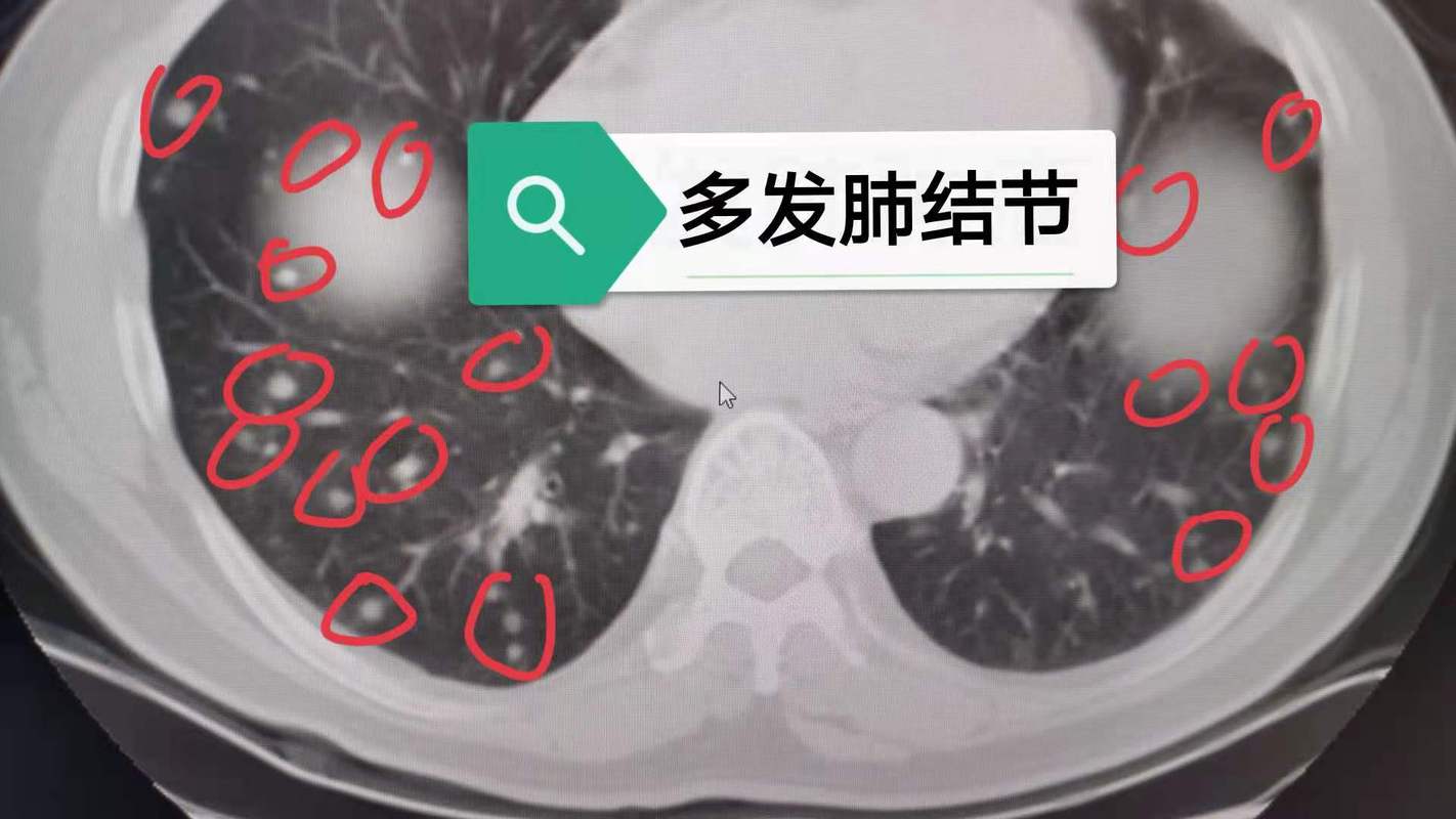 肺部长了结节是什么原因导致的？人为什么会得肺结节呢呢