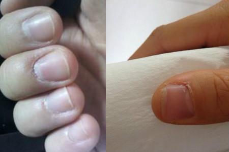 大拇指的指甲和肉分开了，可以告诉我可以怎样处理？指甲为什么跟肉分离呢呢