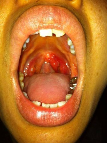 小舌头发痒，一痒就要咳，有粘痰？舌头为什么会经常痒呢呢-图1