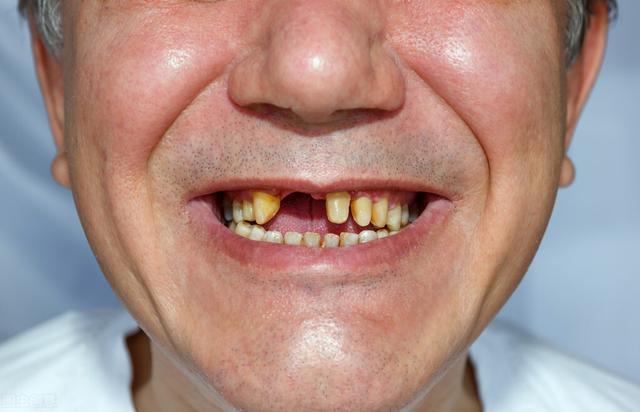 中年人为什么会突然掉牙毫无症状？为什么缺失牙总掉呢呢
